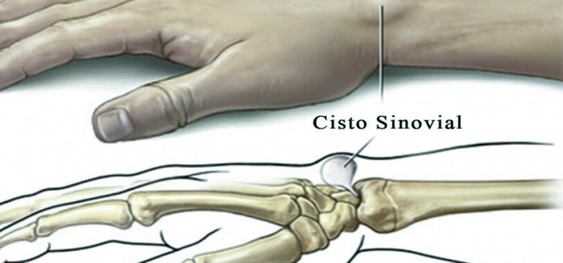 Cisto sinovial: o que é, sintomas, causas e tratamento - Tua Saúde